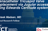 TCT 1406: Transcatheter Tricuspid Valve Replacement via Jugular Access Using Edwards Certitude System