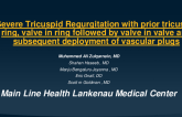 Severe Tricuspid Regurgitation with prior tricuspid ring, valve in ring followed by valve in valve and subsequent deployment of vascular plugs